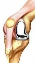 https://www.rijnlandorthopedie.nl/uploads/images/knie/prothese/Knie_uniprothese_1.jpg