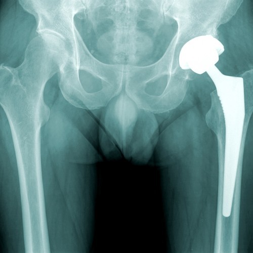 Totale Heupprothese