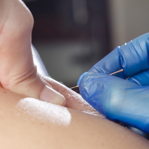 Dry needling