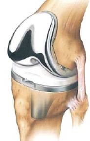 https://www.rijnlandorthopedie.nl/uploads/images/knie/prothese/Knieprothese1.jpg
